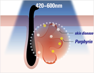 Innovation in Acne Treatment